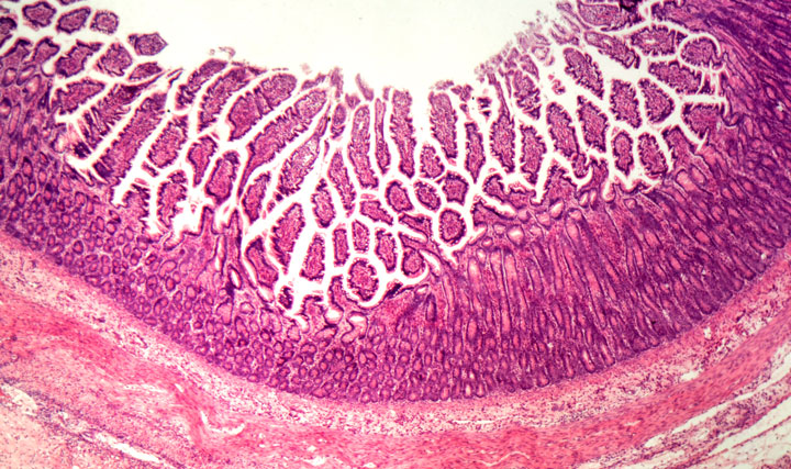 Preparat histopatologiczny jelita grubego – stan zapalny, colitis